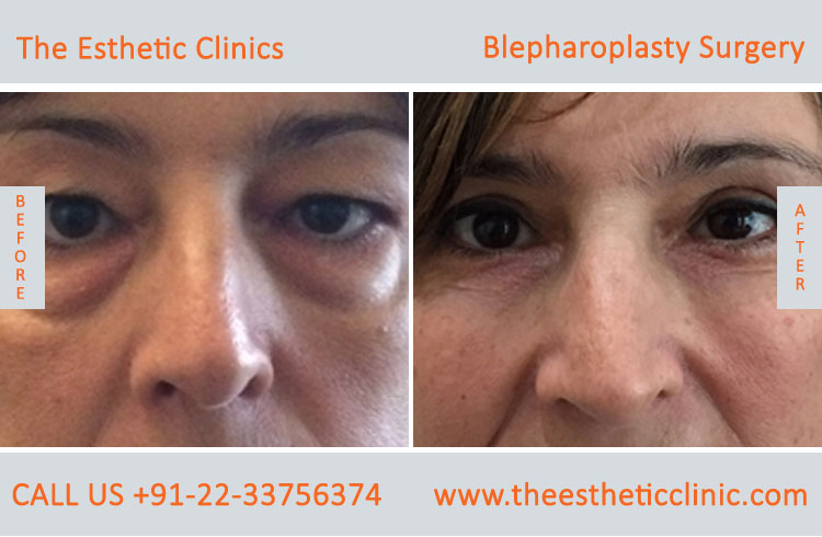 Blepharoplasty Surgery, Eyelid lift surgery before after photos in mumbai india (2)